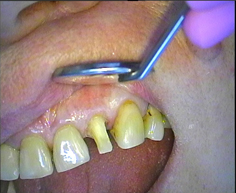 Фото поврежденного зуба