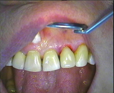 Фото после восстановления зуба