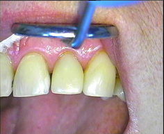 Через месяц после восстановления зуба