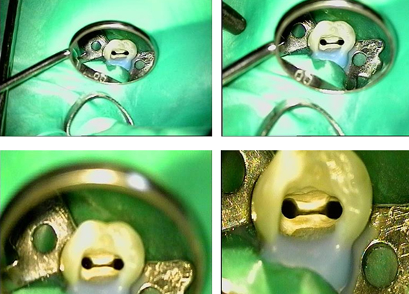 Каналы зуба под микроскопом