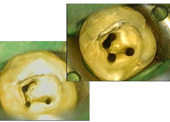 Корневые каналы зубов под микроскопом