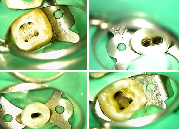 Поиск начала корневых каналов зубов