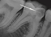 Кариозный процесс на пульпе зуба