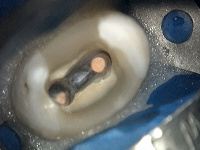 Каналы зуба под микроскопом