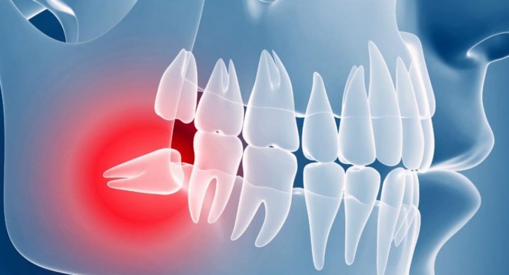 Зуб мудрости — Википедия