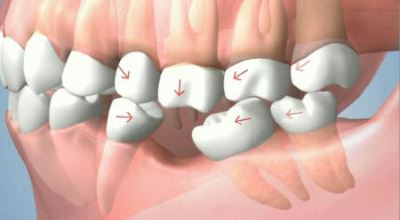 Отсутствующие зубы