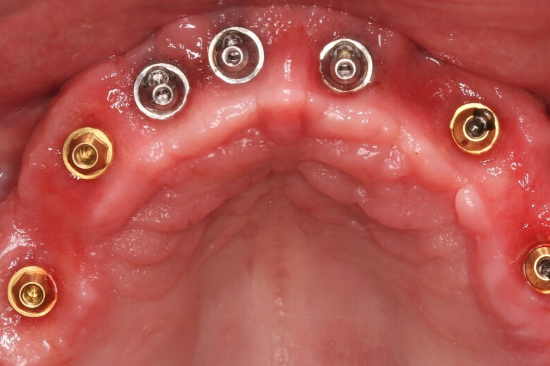 implantatsiya-zubov (2).jpg
